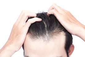 Hair loss Treatment, Top Dermatologist in Islamabad, Best Dermatologist in Islamabad