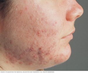 Acne Types, Causes and Preventions