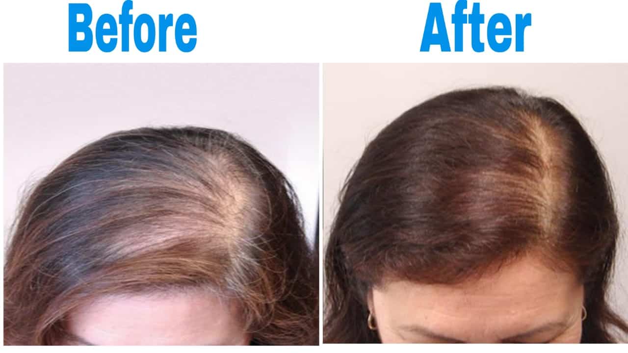 hair loss treatment