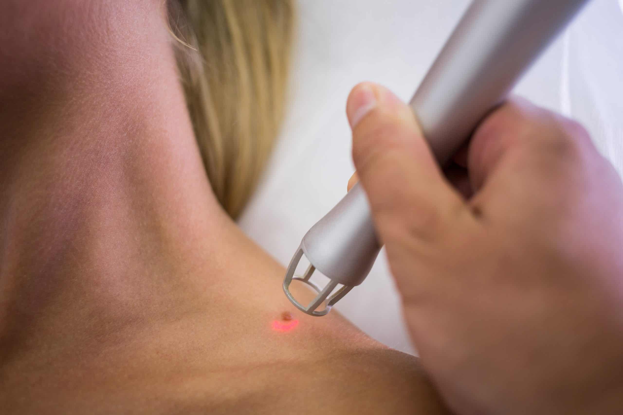 Laser treatment