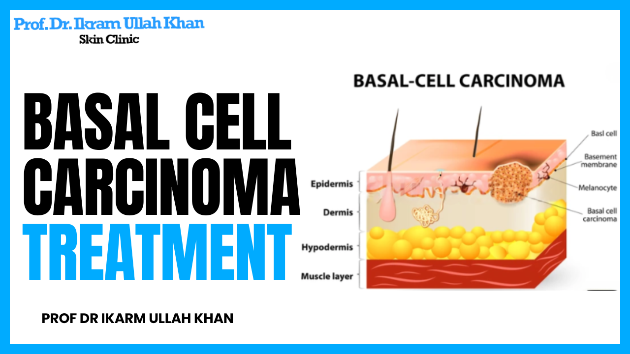 Basal Cell Carcinoma Laser Treatment By Prof Dr Ikram Ullah Khan 