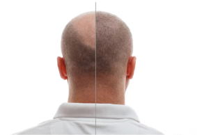 DHI: Debunking Myths and Misconceptions About the Revolutionary Hair Transplant Technique