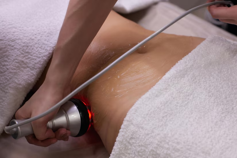 stretch mark laser removal