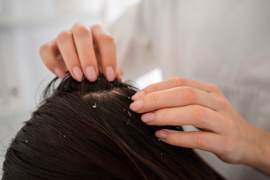 scalp psoriasis