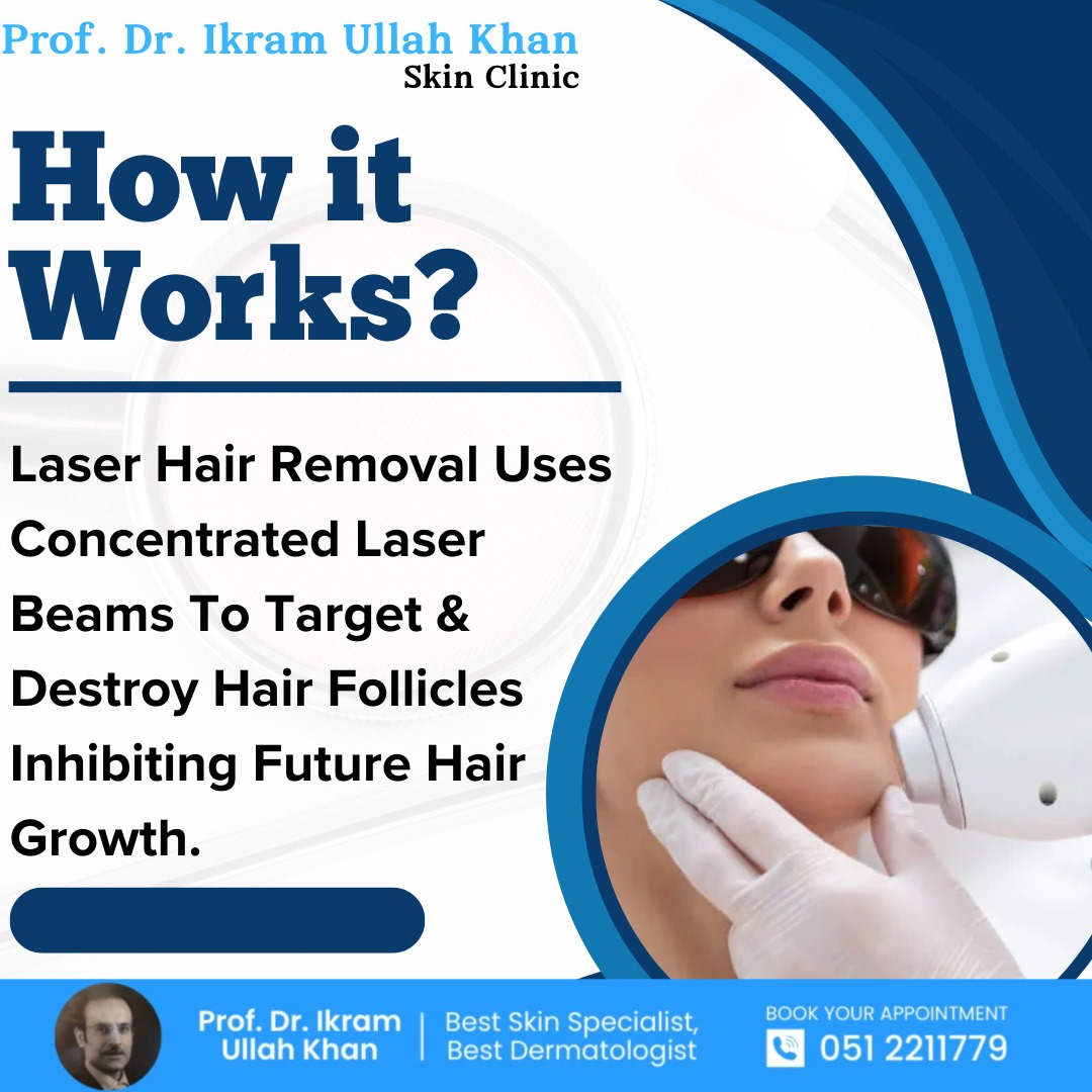 laser hair removal