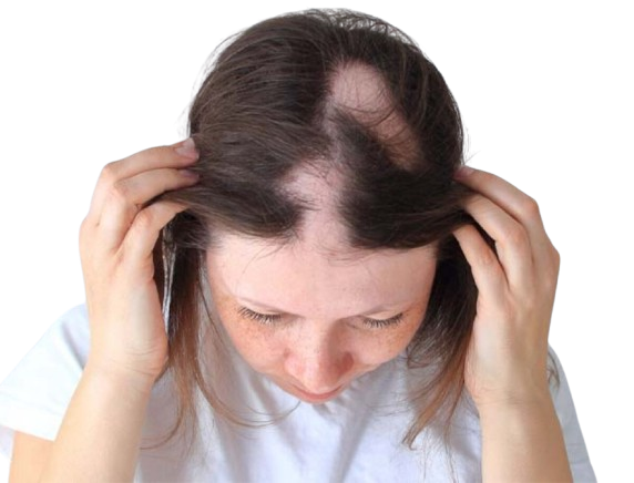 alopecia-areata