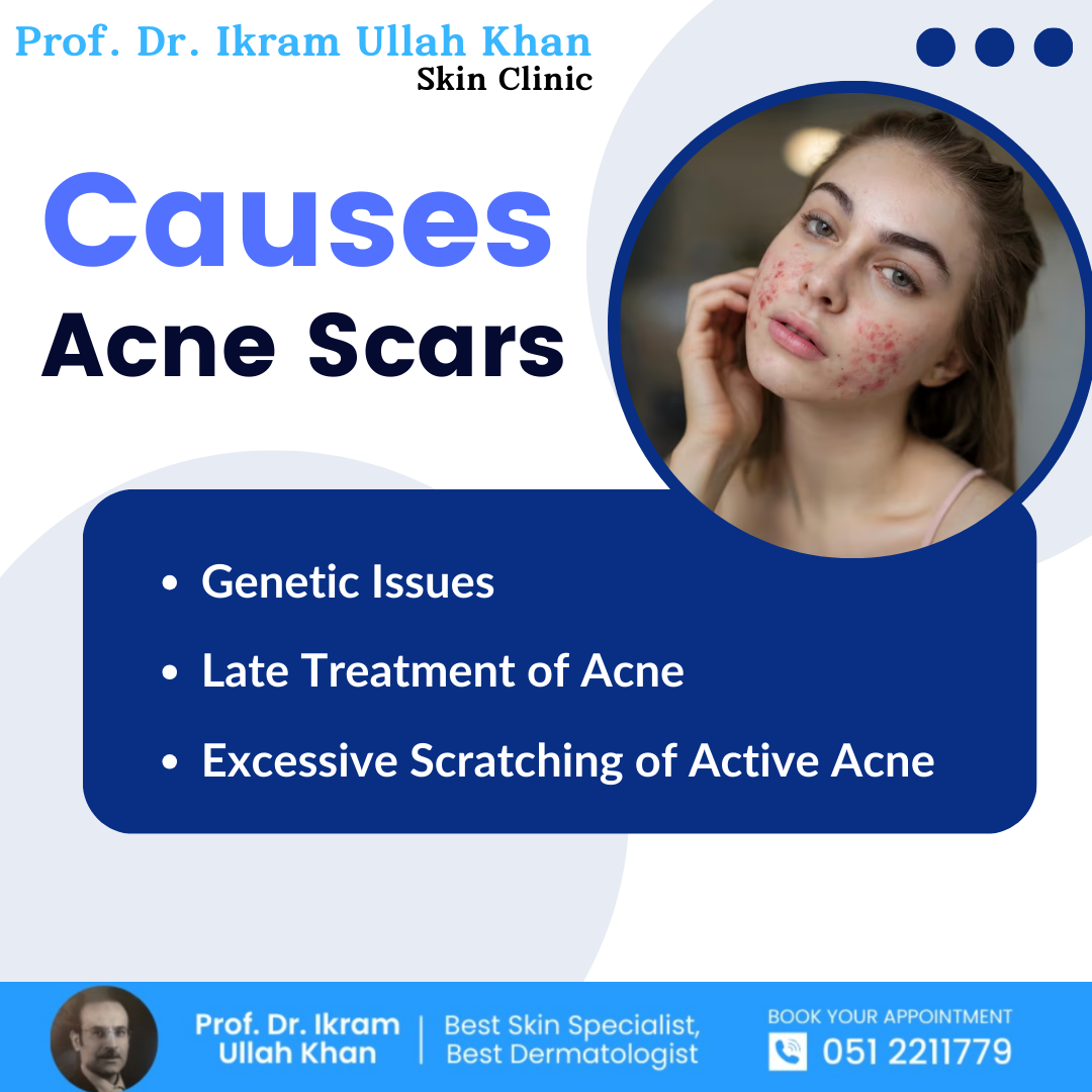 Causes of Acne Scars