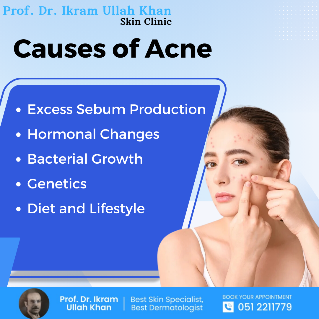 causes-of-acne