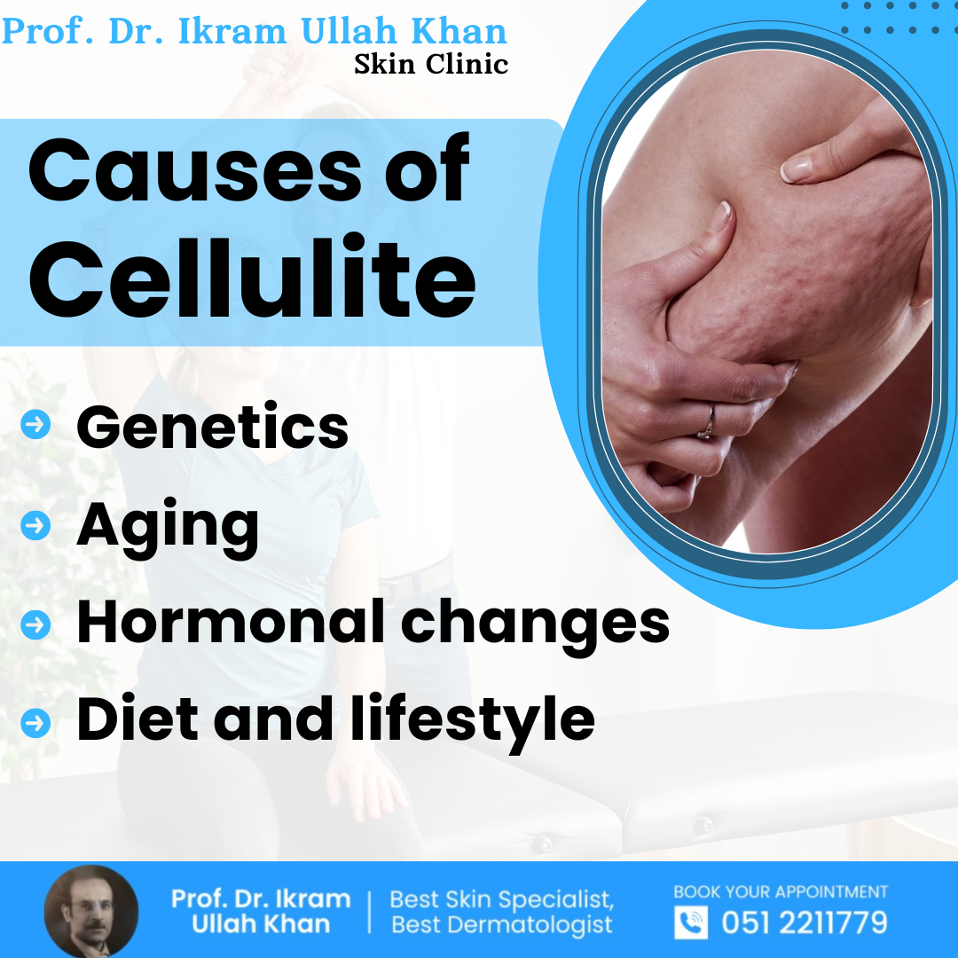 causes-of-cellulite