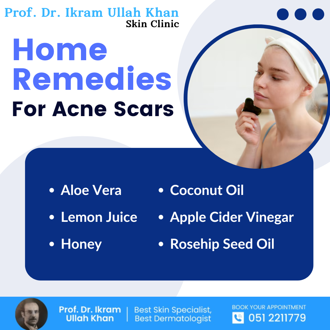 home-remedies-for-ance-scars