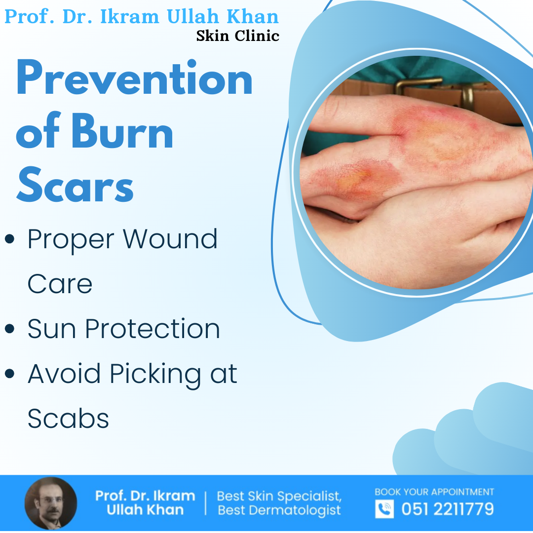 prevention-of-burn-scars