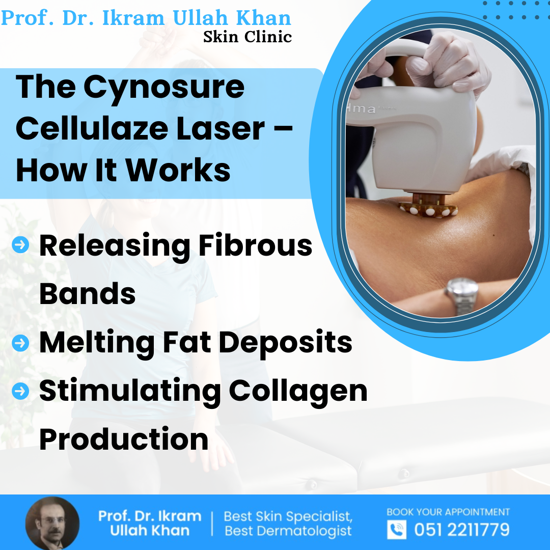 the-cynosure-cellulaze-laser-how-it-works