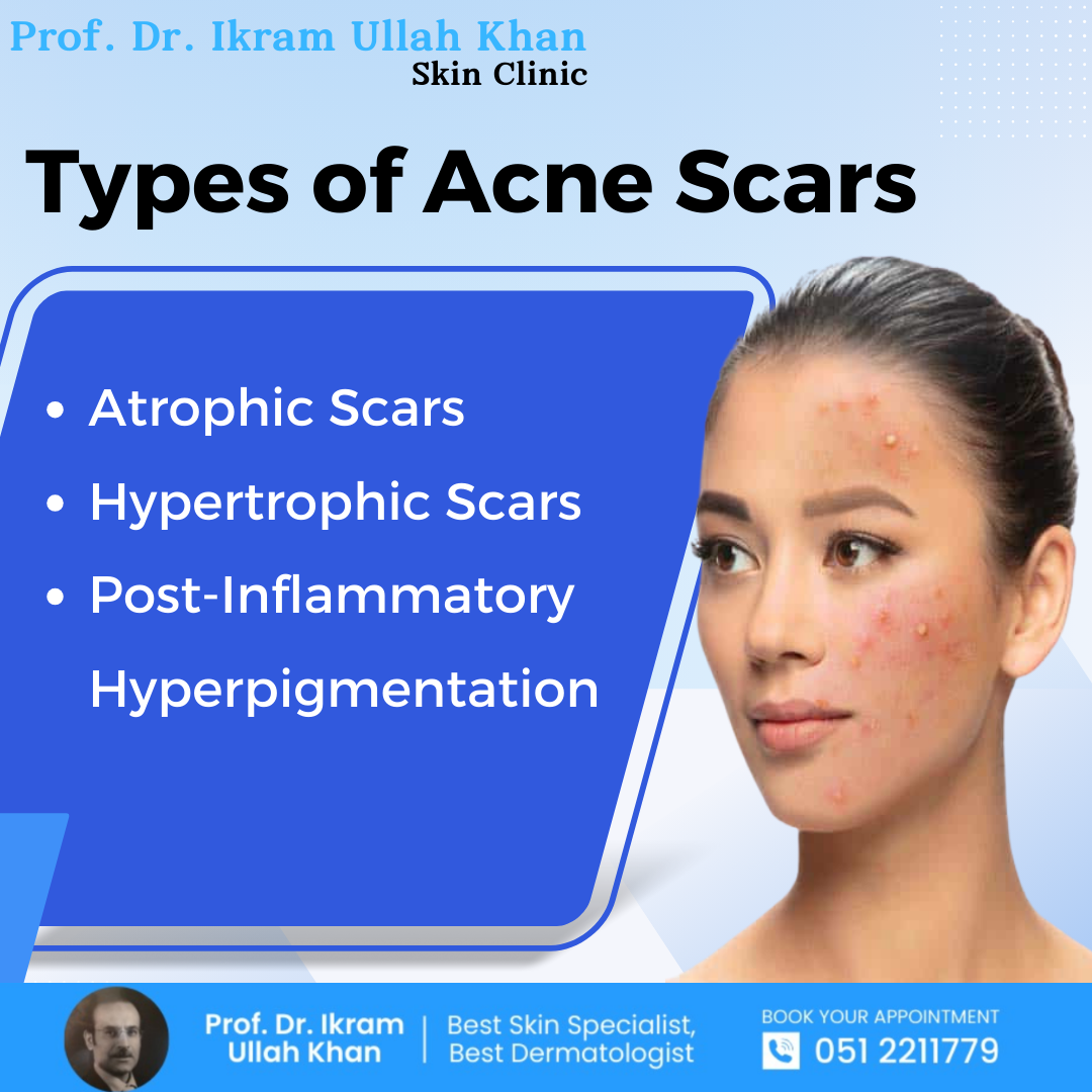 types-of-acne-scars