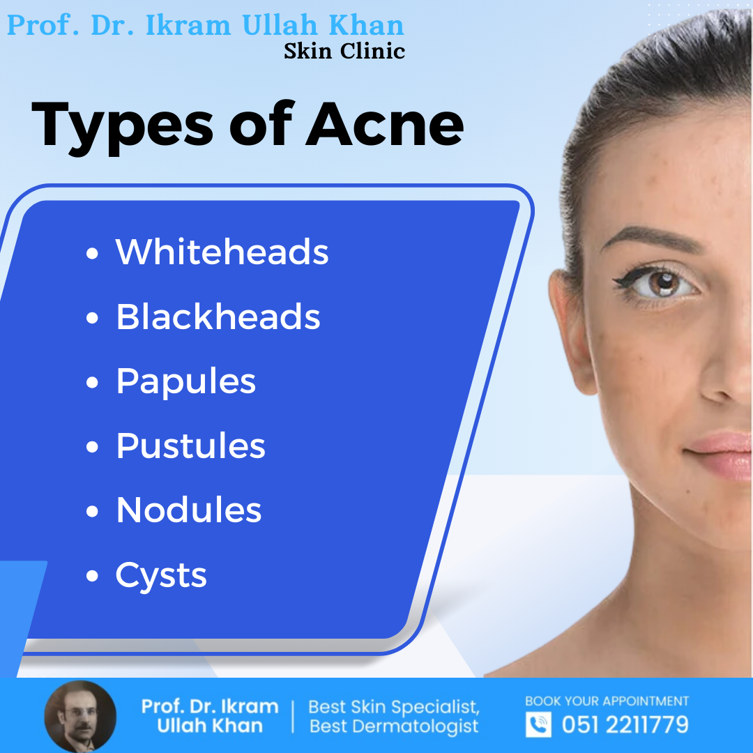 types-of-acne