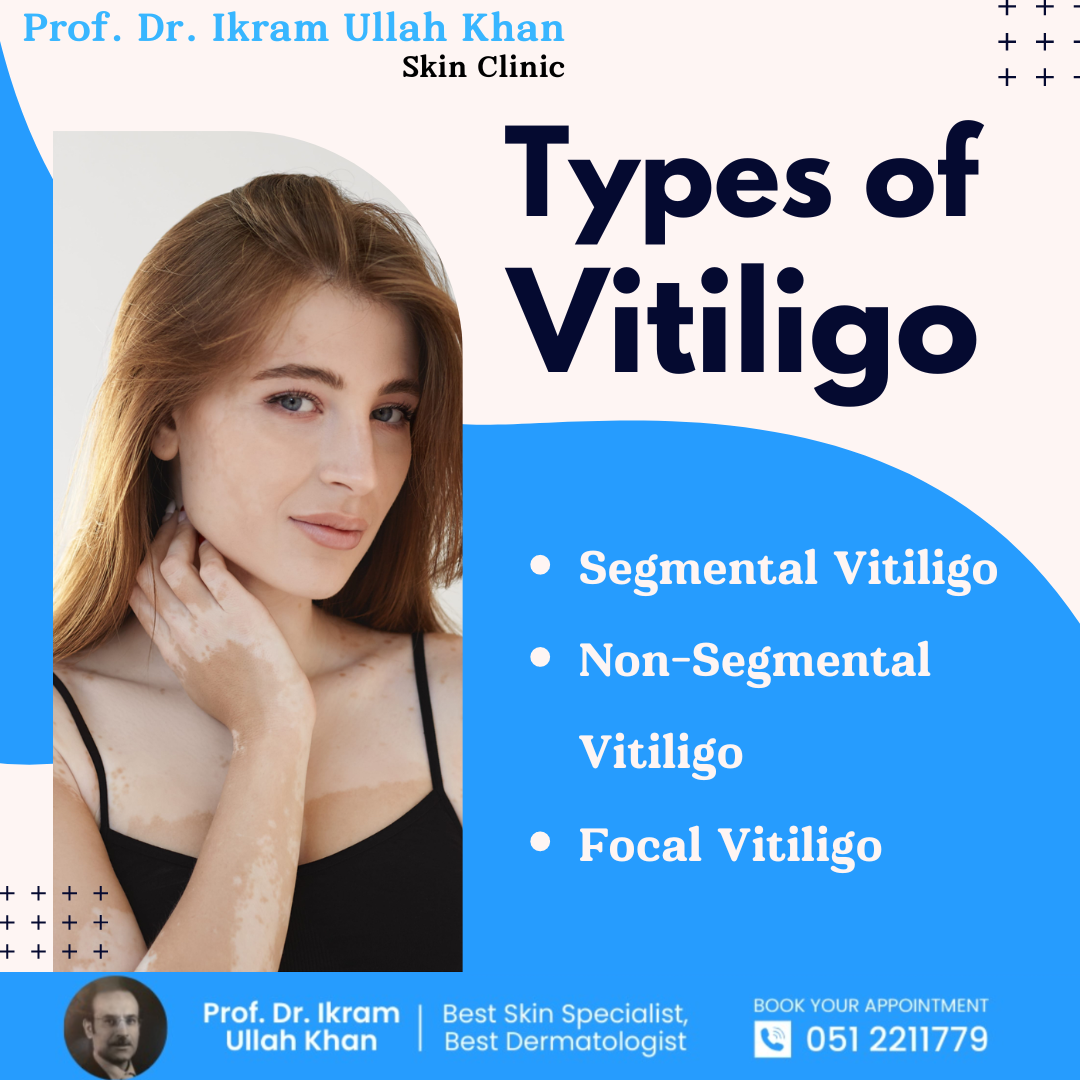 types-of-vitiligo