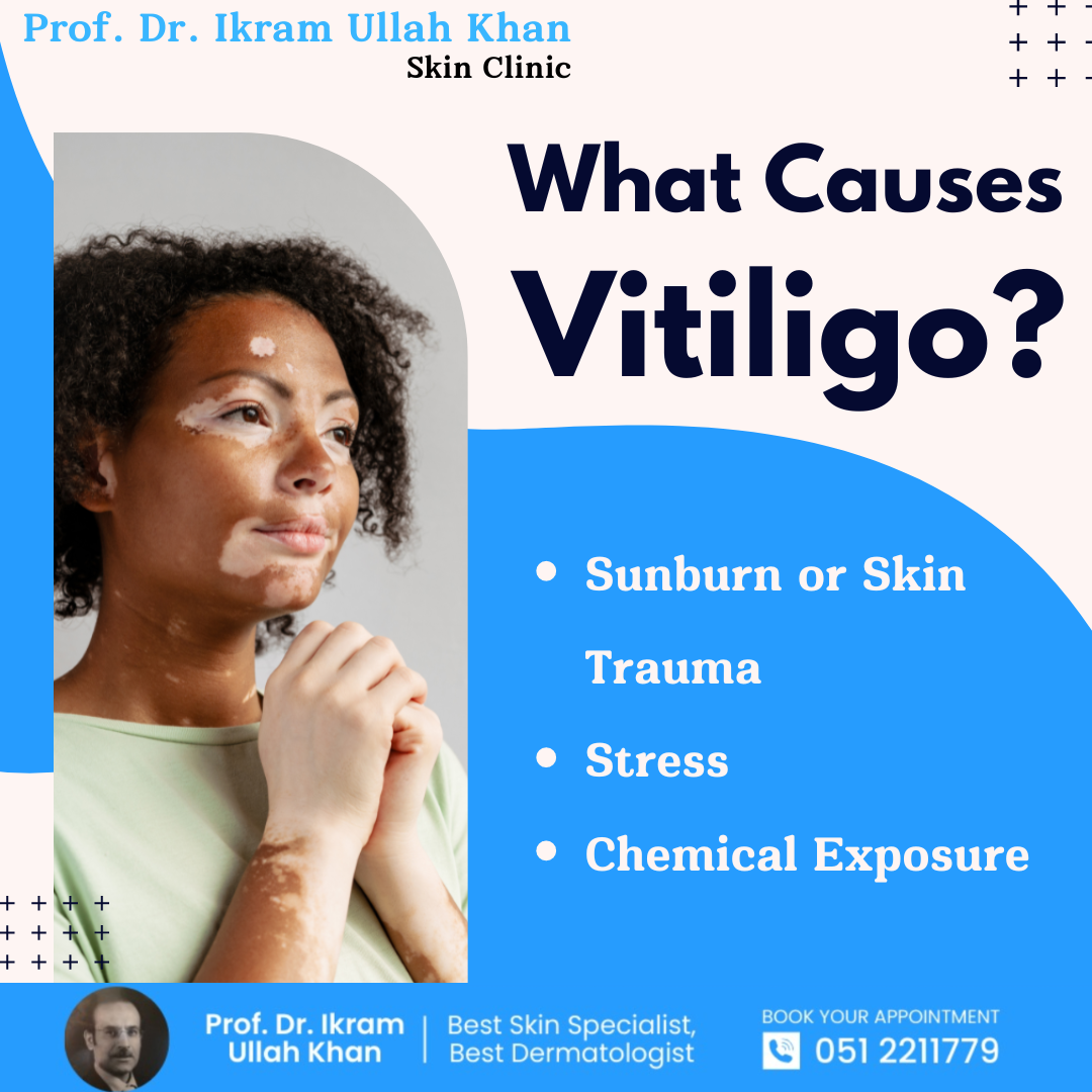 what-causes-vitiligo