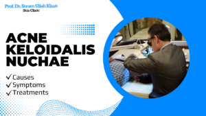 Understanding Acne Keloidalis Nuchae: Causes, Symptoms, and Treatments