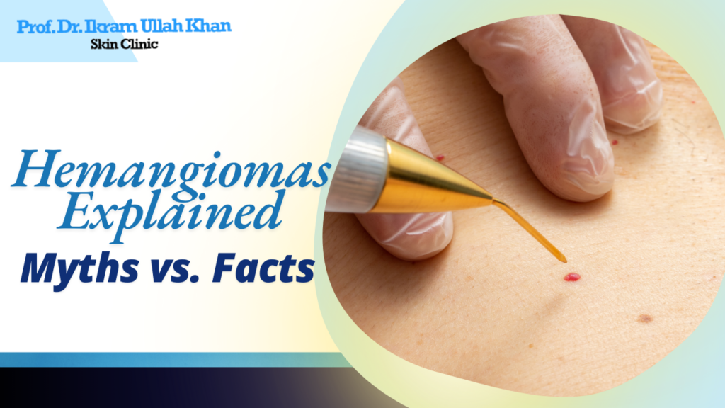 Hemangiomas Explained: Myths vs. Facts