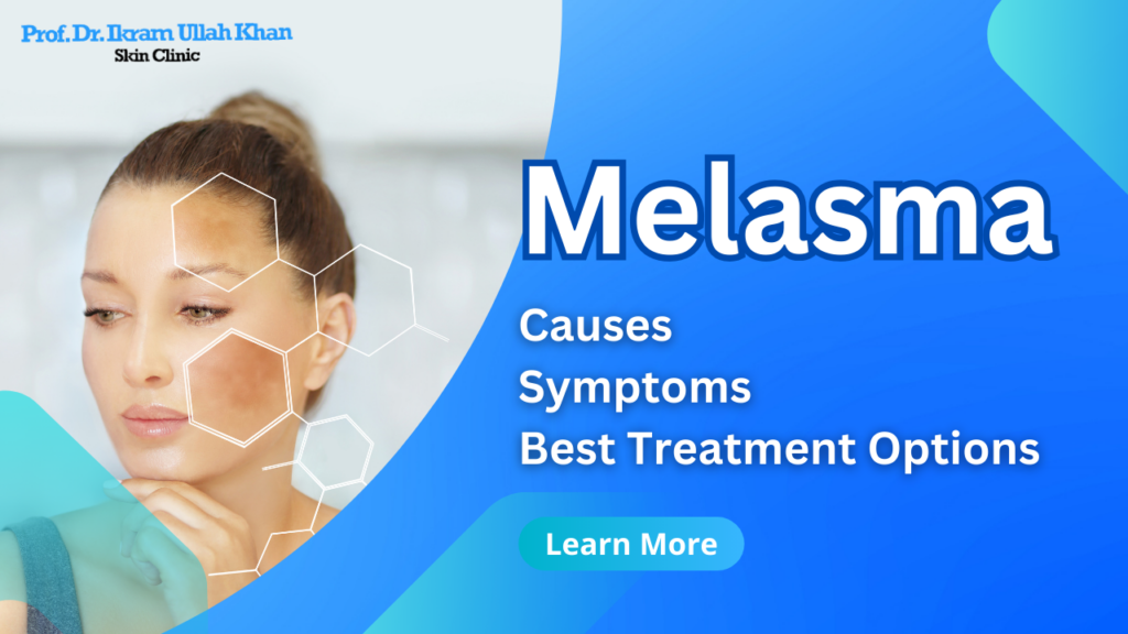 Melasma: Causes, Symptoms, and the Best Treatment Options